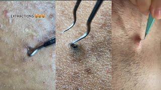 ingrown hair removal Completion 😌 2023 Edition [upl. by Enelez]