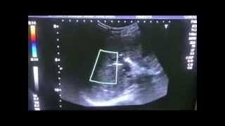 GB MASS with STENT in CBD and PNEUMOBILIA [upl. by Inohs700]