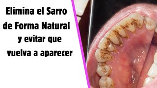 🦷 Elimina la Placa Dental Sarro con Este Remedio Casero Efectivo 💥 [upl. by Jecoa125]