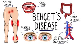 Behcets Disease  Signs and Symptoms with Triad  Pathophysiology  Criteria amp Treatment [upl. by Otho425]