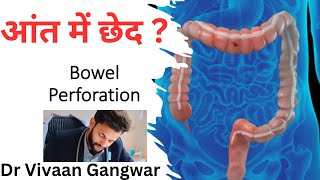 Bowel Perforation  Intestinal Perforations  Bowel Perforation Causes  Intestinal Obstruction [upl. by Nevaj]