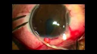 Man with Parasite Worm in Eye  Nematode Worms in Eyeball [upl. by Buckden616]