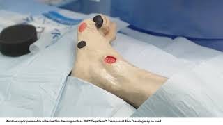 Application tips 3M™ VAC® Dressing Application Bridging Technique on Foot Wound [upl. by Aihseym]