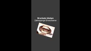 Zahnspange Erwachsene  Brackets kleben shorts [upl. by Ecinreb644]