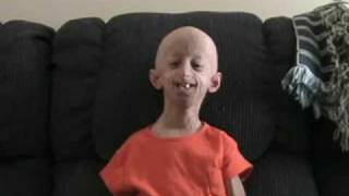 Progeria  An unneeded suffering without a cause [upl. by Murial]