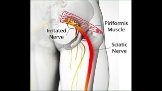 Síndrome do Piriforme Liberação Miofascial DOR CIÁTICA  Clínica de Fisioterapia Dr Robson Sitta [upl. by Sirod]