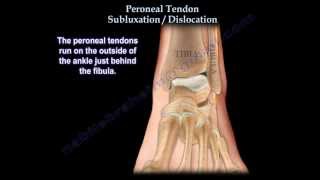 Peroneal Tendon Subluxation  Dislocation  Everything You Need To Know  Dr Nabil Ebraheim [upl. by Kannan]