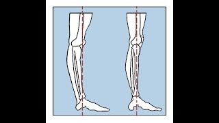 One Minute Anatomy Hyperextension of the knees [upl. by Newhall]