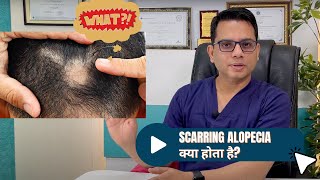 Scarring Alopecia  Lichen planopilaris  Hair fall Treatment in Delhi  Dr Jangid  SkinQure Delhi [upl. by Jehu]