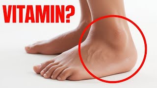 1 Vitamin to Eliminate Swelling in Feet and Legs [upl. by Kimmi]