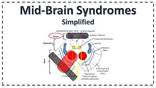 MidBrain Syndromes  Weber Syndrome  Benedikt Syndrome  Parinauds Syndrome [upl. by Ahsitahs21]