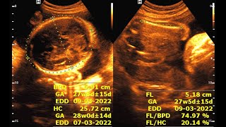 Sonographic evaluation at 37 weeks of pregnancy [upl. by Sillert]