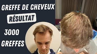 Résultat de la greffe de cheveux 3000 greffons l Avant et après l Greffe de cheveux en Turqui [upl. by Dahaf]