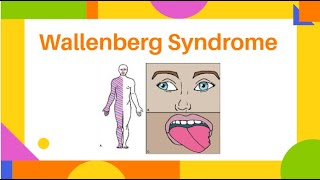 Wallenberg Syndrome  Lateral Medullary Syndrome  PhysiotherapyKnowledge [upl. by Cronin864]