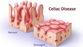 Celiac Disease [upl. by Ahseiat65]