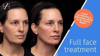 Full Face Dermal Fillers Treatment Demonstration by Dr Tristan Mehta [upl. by Oetsira]