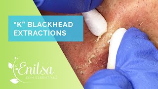 Blackhead amp Whitehead Extractions on quotKquot Part 4 [upl. by Nabla71]