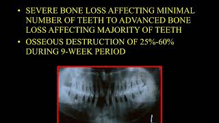 Topic Aggressive Periodontitis For Final Year BDS [upl. by Nnylsoj941]