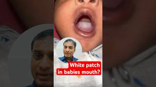 White patches on babies mouth baby tamilhealthtips drshahulrmukundan [upl. by Eiramyma406]