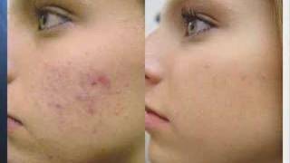 Acne Treatment with Fotona Laser [upl. by Reitman]