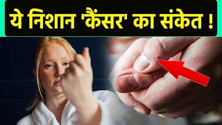 नाखून पर निशान कैंसर का संकेत । Nails पर निशान Cancer का Symptom Doctors Advice  Boldsky [upl. by Siffre467]