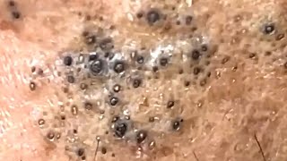 Blackheads Satisfying Removal 0003 [upl. by Alberta]