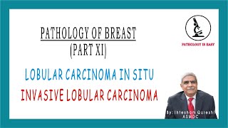 Lobular Carcinoma In Situ and Invasive Lobular Carcinoma by Dr Ihtesham Qureshi [upl. by Anwat]