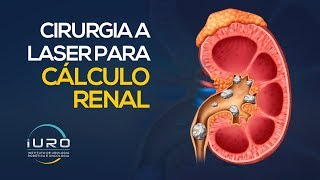 Cirurgia a Laser para CÁLCULO RENAL Pedra nos rins [upl. by Anilorac495]