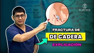 TIPOS DE FRACTURA DE CADERA  intracapsular vs extracapsular [upl. by Favin]