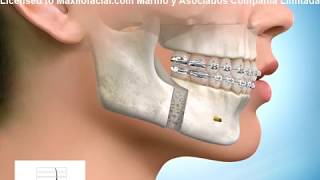 Avance MaxilarMandibular para vía aérea [upl. by Mellicent]