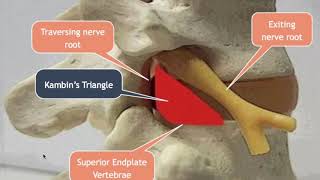 Lumbar Transforaminal Approach for Disc Herniations [upl. by Londoner]