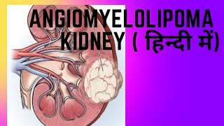 Angiomyelolipoma AML of kidney  एंजियोमायोलिपोमा एएमएल किडनी [upl. by Rollin]