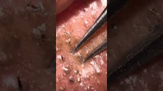 Ingrown hair plucking  tweezing ASMR [upl. by Rovner]