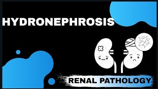 HYDRONEPHROSIS  Renal pathology   Med Bees [upl. by Marsh]