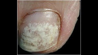 Keratin Granulations  White Toenails Best Home Treatment [upl. by Ontine]