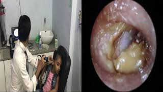 Best ear wax removal ever  How to remove earwax  EXTRA large ear wax in small child [upl. by Rosel982]