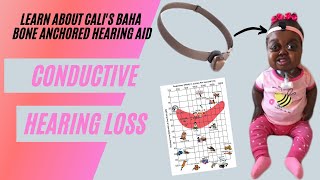 WHAT IS CONDUCTIVE HEARING LOSS  HOW DOES THE BAHA WORK LEARN ABOUT CALIS HEARING LOSS [upl. by Adnoyek]