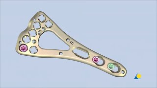 Radius Distal  Intraarticular Fracture Fixation Using VALCP Volar TwoColumn Distal Radius Plate [upl. by Nyleda667]