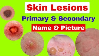 Type of skin lesions with name and picture  Primary and secondary skin lesions  skin diseases [upl. by Breed763]