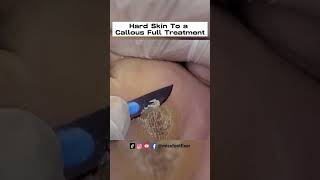 Hard Skin To a Callous  🦶 Why Does This Happen  Full Treatment by Foot Specialist Miss Foot Fixer [upl. by Annice]