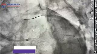 Left Main Ostial IVUS guided Angioplasty by Dr Rhishikesh Umalkar [upl. by Isabeau]