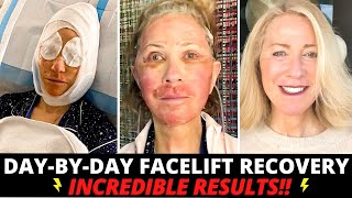 68 Year Old Undergoes Incredible Facial Plastic Surgery Transformation Day by Day Healing Process [upl. by Perpetua]