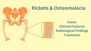 Rickets amp Osteomalacia Causes Clinical features Radiological features Treatment [upl. by Oicnedurp455]