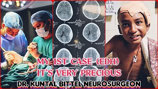 1st Case As NeuroSurgery Resident  Its Precious  Extradural Haemorrhage  EDH  Complete Recovery [upl. by Egidius989]