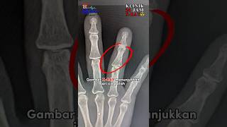 Xray nampak ada retak [upl. by Duane591]