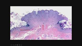 From Nevus to Melanoma How Melanocytes Become Malignant Morphologically and Molecularly [upl. by Song]