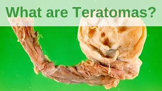 What are Teratomas  Pathology mini tutorial [upl. by Tung]