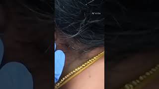 Non surgical ear lobe treatment  painless earlobe [upl. by Anhavas466]