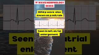 Morphology of p wave in ecg learnecg [upl. by Omolhs]