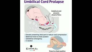 💠 Umbilical cord prolapse 💠 [upl. by Ecnahc]